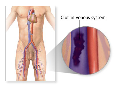 DVT Example 3
